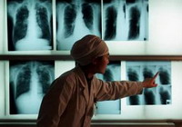 Dva miliona ljudi umre godišnje od TBC
