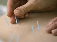 Možda samo vera pacijenata čini akupunkturu delotvornom