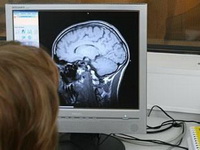 Zahvaljujući proteinu: Naučnici će moći otkriti Alzheimerovu bolest 10 godina prije pojave prvih simptoma