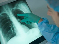 Veštačke bronhije: pomak u lečenju raka pluća