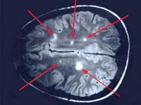 Nova saznanja o multiploj sklerozi